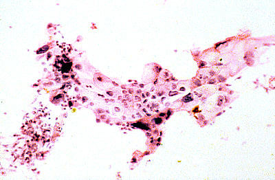 Obraz cytologiczny raka trzustki w materiale z biopsji aspiracyjnej cienkoigłowej